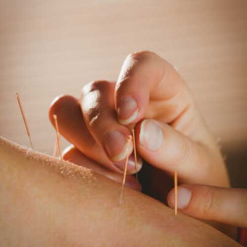 Acupuncture Session
